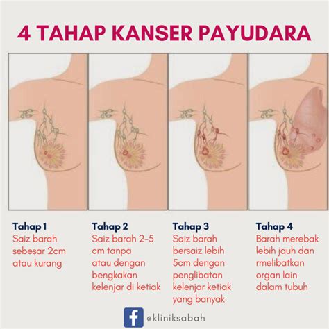 infografis selain benjolan, ini gejala awal kanker payudara kanker payudara jadi penyakit mematikan yang banyak. 4 tahap kanser yang anda perlu tahu - Klinik Sabah