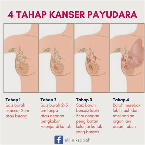 Info kanser > senarai kanser. 4 tahap kanser yang anda perlu tahu - Klinik Sabah