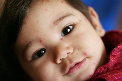 Chicken pox is given by airborne droplets (during conversation, coughing, sneezing). "Chicken Pox": Cacar Air terhadap Kanak-kanak - Hello Doktor