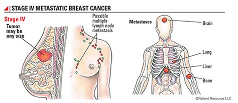 The symptoms of metastatic breast cancer can be very different depending on the location of the cancer: Understanding Breast Cancer Metastasis - Symptoms Check