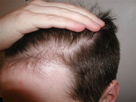 It typically means that you have a low amout of protein, iron, and zinc in your blood. The key causes of thinning hair misery that strike ...