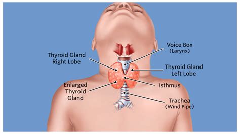 If your doctor thinks you may have a higher risk of developing cancer, they can recommend tests or watch for certain signs of the disease. Apa Itu Graves Disease: Penyebab, Gejala Pengobatan ...