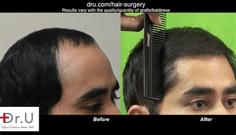 Regardless of the reason and nature of hair loss, however, one fact rings true for most who go. Video - Norwood 1 Full Hair Restoration Using Body Hair ...