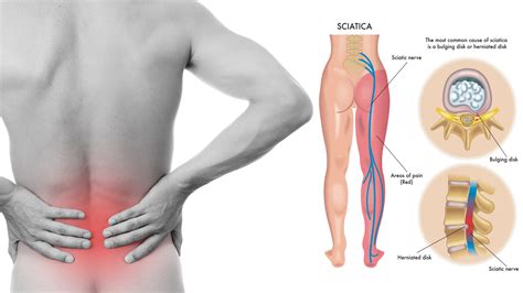 Sciatic nerve irritation causes pain that radiates down the leg from the low back or buttocks. Sciatica Pain Relief | Chiropractic Care | Sciatic Nerve ...