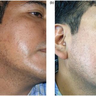 The recalcitrant warts cleared in all three patients beginning in the fourth and fifth weeks after daily treatment with the pads. (a) A 47-year-old male with 52 recalcitrant facial flat ...