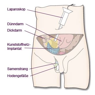 Bei einem leistenbruch gleitet aus verschiedenen gründen gewebe des bauchraums durch die leiste. Leistenbruch, Hernie, Leistenhernie, minimalinvasive Operation