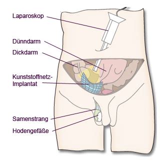 Bei einem leistenbruch gleitet aus verschiedenen gründen gewebe des bauchraums durch die leiste. Leistenbruch, Hernie, Leistenhernie, minimalinvasive Operation