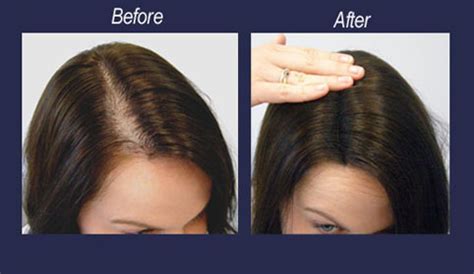 Biotin is one of the most popular hair loss supplements. Hair Loss Prevention & Care - Hair Growth Supplements ...