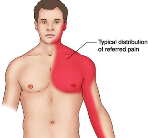 Minor factors include concomitant myocarditis, immunodepression, trauma and oral anticoagulant. Diseases Of The The Myocardium And The Pericardium ...