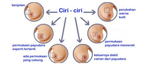 Serviks kanseri (servikal kanser) nedir? Kanser Pangkal Rahim Tahap 2 - Zafrina