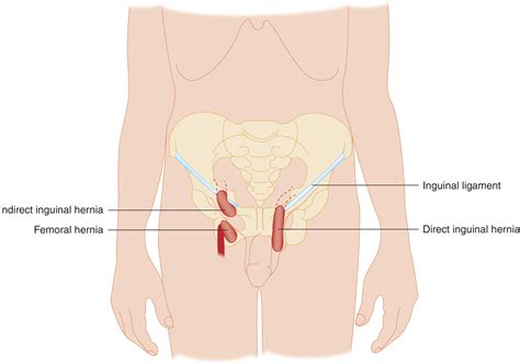 Surgery to repair an inguinal hernia is generally safe and complications are uncommon. HERNIA IN ADULTS AND CHILDREN | Anesthesia Key