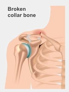 Finding a lump on the collarbone can be concerning. Broken collar bone (fractured clavicle)