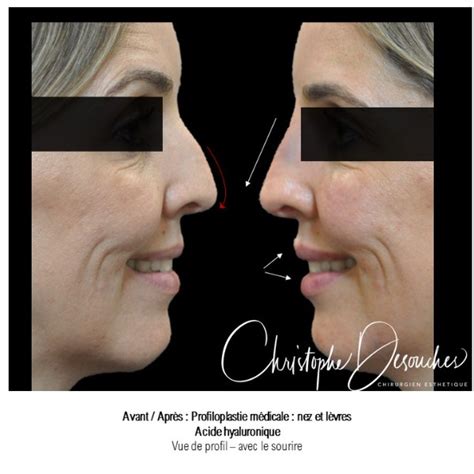 Hyalogic, acide hyaluronique pour les articulations, la peau et les yeux, saveur de baies mélangées, 60 pastilles ah à croquer. Profiloplastie médicale - acide hyaluronique à Marseille ...