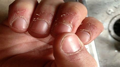 You can also relieve pain and itching, and help speed up. WHY YOU SHOULD NEVER EVER RIP OFF YOUR HANG NAILS | Uñas ...