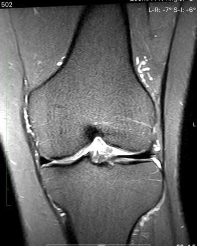 Ein mrt knie bei aristra werden in zusammenarbeit mit international anerkannten experten und expertinnen für die muskuloskelettale (msk) bildgebung fortlaufend weiterentwickelt. MRT Knie - erste Einschätzung? (Gesundheit und Medizin ...