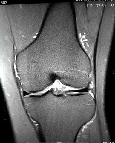 Anatomiequerschnitte auf der grundlage medizinischer bildgebung (scanner, mrt, röntgenaufnahmen) und makroskopischer anatomie ausgehend von medizinischen abbildungen. MRT Knie - erste Einschätzung? (Gesundheit und Medizin ...