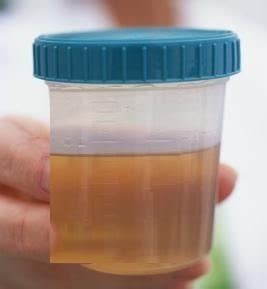 Blood in your urine can be alarming, jennifer linehan, m.d., urologist and associate professor of urologic oncology at the john wayne cancer institute at providence saint john's health center in santa monica, california, tells self. Blood in Urine of Female Have Irregular Periods - Blood ...
