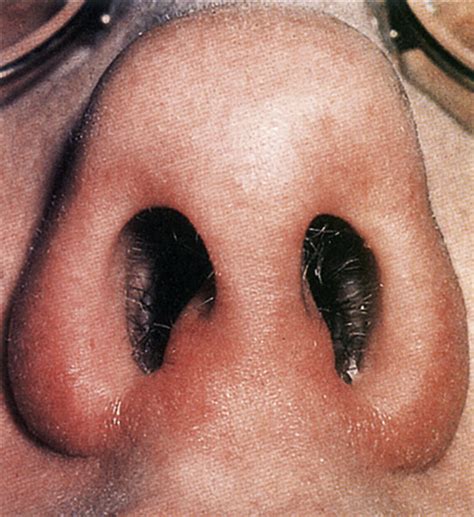 We utilized a retrospective chart review of cancer. Rhinitis, Acute (Runny Nose) | Anesthesia Key