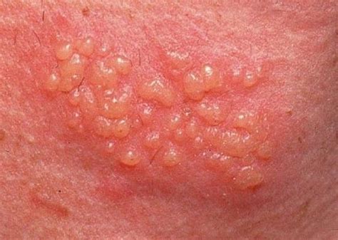 Both herpes simplex viruses 1 and 2 produce similar symptoms, but they can differ in severity depending on the site of infection. Herpes Symptoms in Women: Genital Herpes Diagnosis, Treatment
