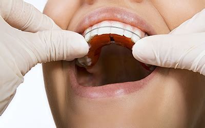 If you recently started wearing retainers or if you simply want to learn how to take care of them in the right way, the article below will be able to shed however, a lot of people that wear retainers don't wash them frequently, which is a really big mistake since the identical bacteria that form in your teeth. Properly Cleaning Your Dental Retainer