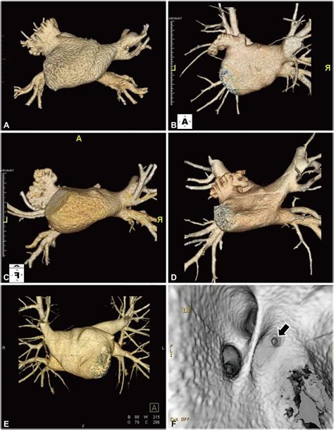 .was 'cactus' in 30% of cases, 'chicken wing' (48%), 'windsock' (19%) and 'cauliflower' (3%). The Role of Multimodality Cardiac Imaging in the ...