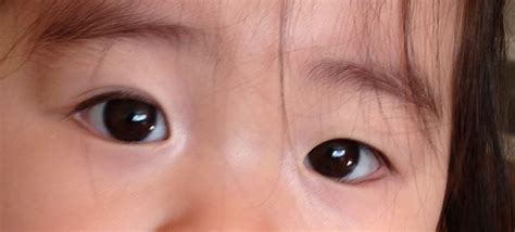 Although bumps can disappear on their own, simple treatment at home often speeds up healing. C-Bao & Co.: Eyelid Flip