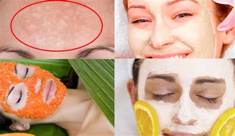 ¿tienes manchas irregulares y simétricas que han aparecido después de exponerte al sol? Melasma tratamiento natural Casero Efectivo - Cv Interesante