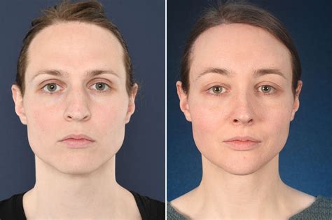 There are many reasons why someone might develop acne on their forehead, and they can often treat the condition at home. Simone before and after FFS - 2pass Clinic