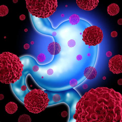 However, as stomach cancer grows and spreads, it exhibits some telltale signs and symptoms, even while still in the early stages. Stomach Cancer Stages - eHealthIQ