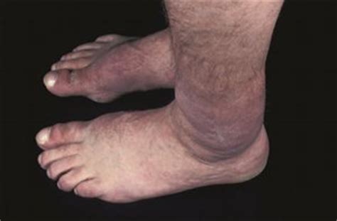 A small percentage of people with graves disease develop a skin abnormality called pretibial myxedema or graves dermopathy. Autoimmune Thyrotoxicosis: Diagnostic Challenges