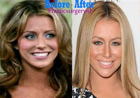 Find out all of the information about the oerlemans plastics bv product: Aubrey O'Day Before and After Plastic Surgery Pictures ...