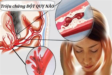 Nhưng hiện nay, tỉ lệ người dưới 45 tuổi. Giải đáp thắc mắc: Triệu chứng đột quỵ não là gì?