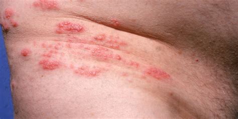 Why Are Shingles Cases Rising In The U.S.? | HuffPost