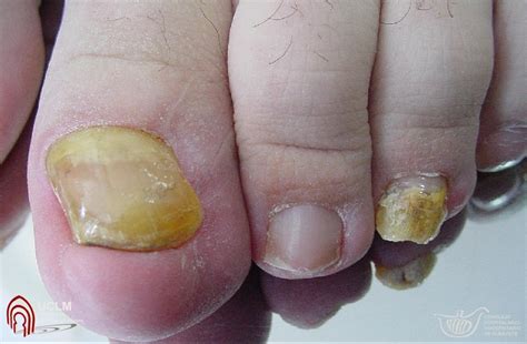 Corticide intralesional acetonido de triamcinolona 10mg/ml 0,2 a 0,4ml por unha. Tiña ungueal