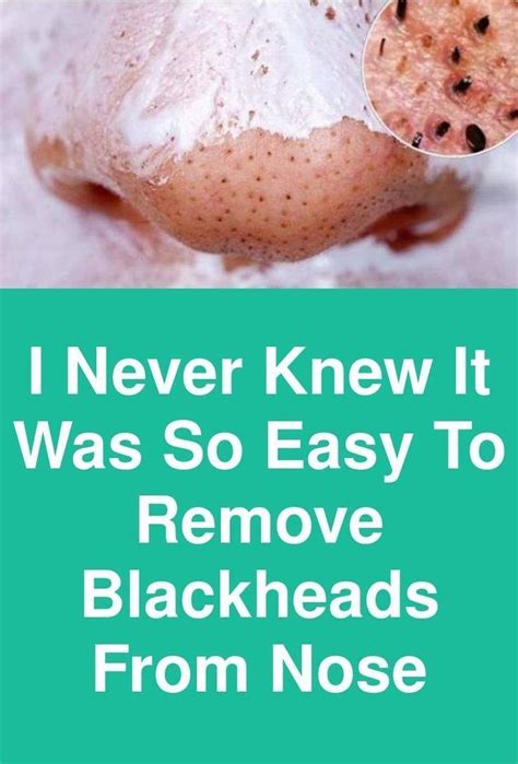 In such a case, you may have to apply some scotch tape on the skin and gently rip it to remove the thorns that are lodged deep. Pin on Skin Care Tips For Blackheads