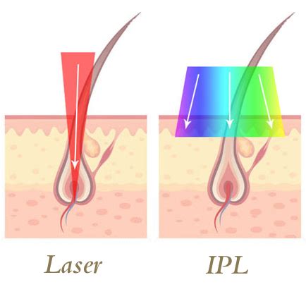 Ipl proved as popular as laser hair removal and many clinical studies led to improvements in home laser and ipl devices follow the same selective photothermolysis approach as professional machines. Wat is het verschil tussen IPL en DPL (laser)? - Palais ...