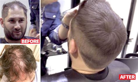 Inventive ways to cover bald spots abound; Miracle product CURES baldness in under 10 minutes | Life ...