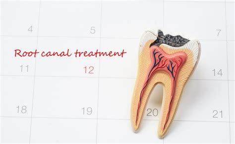 Plan meals carefully for the first few days. Root Canal Procedure | Who Performs it and What Does it Cost?
