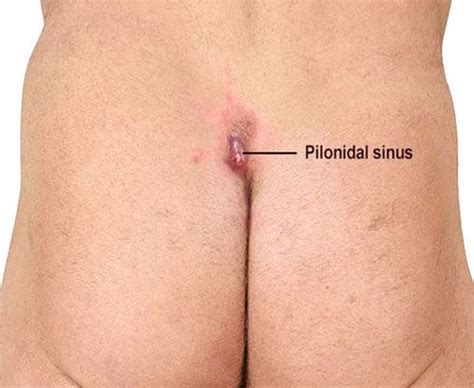 As such is it often also termed an intergluteal pilonidal sinus. PILONIDAL SINUS - www.medicoapps.org