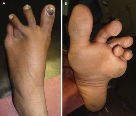 Correction of a Forefoot Deformity Caused by a Large ...