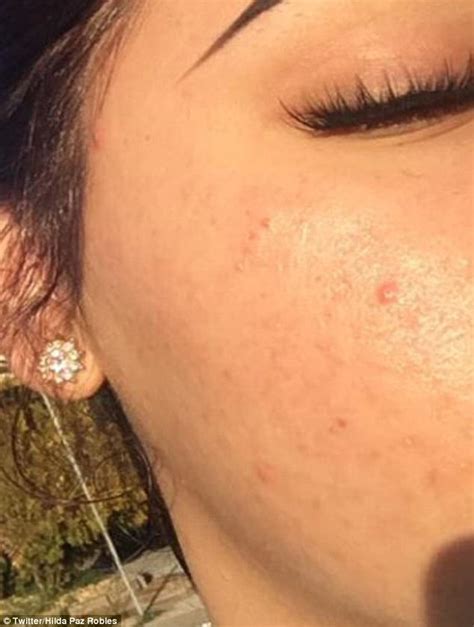 Here's how to tell the difference from regular hormonal acne and how best to treat it. Vegas teen swears green tea and honey cleared cystic acne ...