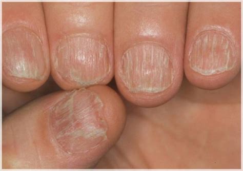 Las uñas negras con hongos siempre presentan un patrón sintomático bastante puntual el cual te nombrare a continuación. Eliminar los hongos en las uñas de los pies y las manos ...