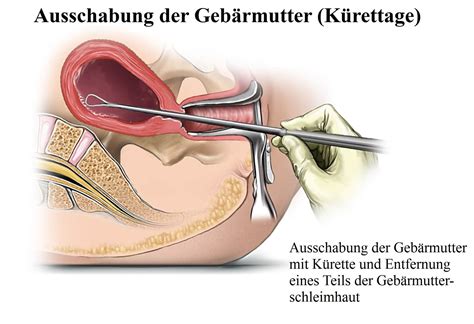 Könntest du mich bitte …. gebärmutter ausschabung video