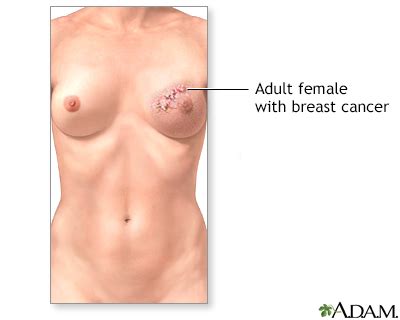 Breast cancer stages breast cancer is the most common form of cancer that affects women. Breast reconstruction - series