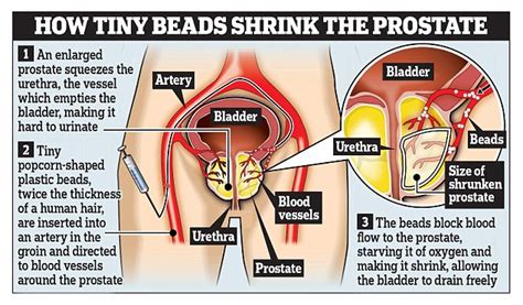 The abnormal cells continue living, when other cells would die. Thousands of men to benefit from new prostate therapy ...