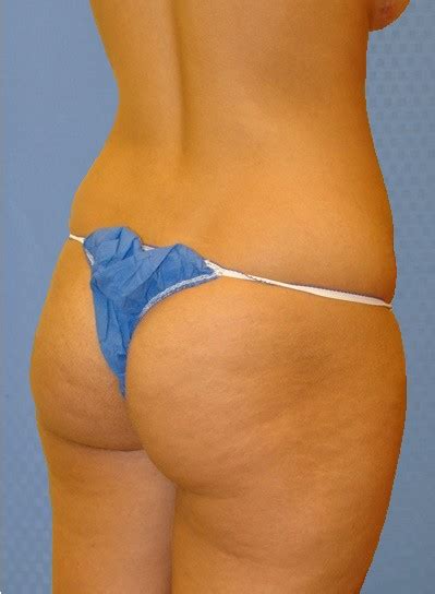 In the early days, you will feel pain both in the area where the fat is removed and your buttocks. Buttock Augmentation: - Dr. Maan Kattash - Cirugía ...