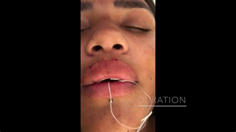 Unfortunately, as we grow older, both the natural production of hyaluronic. Training in Lip Fillers - YouTube