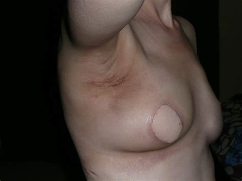 Some warning signs of breast cancer are— new lump in the breast or underarm (armpit). Turning 30 with Breast Cancer