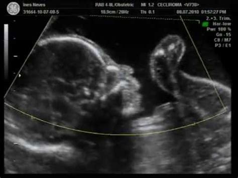 É por isso que muitos anemia fisiológica observada grávida. Ecografia Morfológica Maria Francisca - 22 semanas - 2D/3D ...