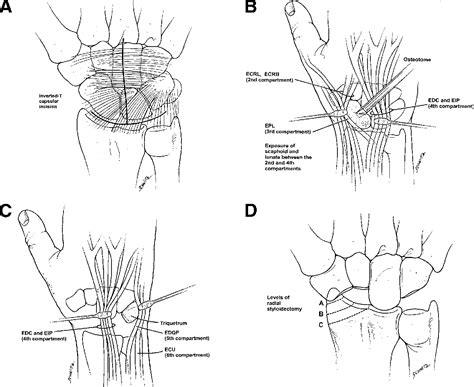 Proximal row carpectomy (prc) is one of several surgical options for patients with advanced wrist arthritis. Figure 2 from Proximal row carpectomy | Semantic Scholar